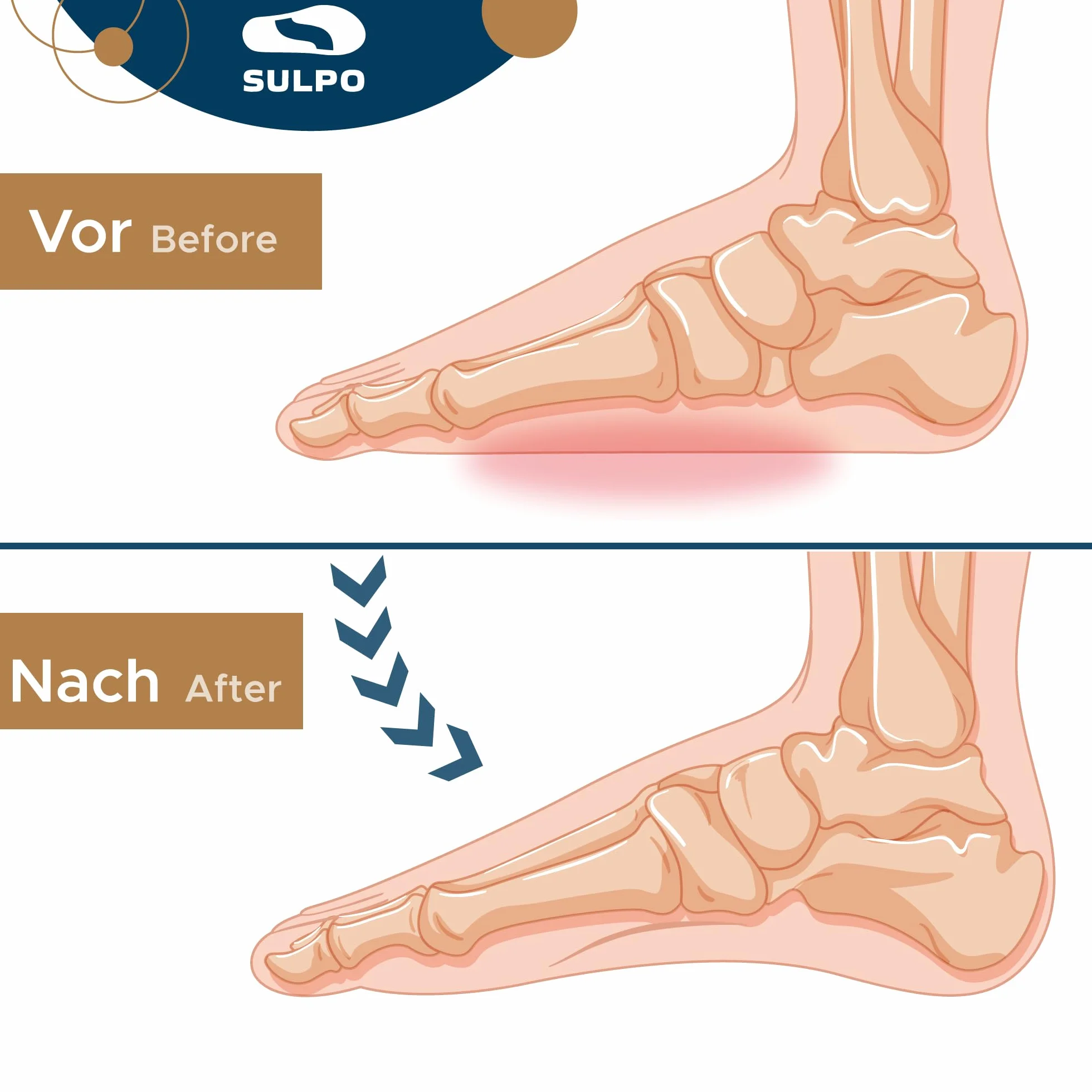 SULPO Taloneras para fascitis plantar y espolon calcaneo - Protector talon 3/4 Plantillas ortopedicas - Almohadillas para talones 40-43 L
